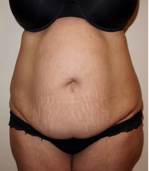 After &mdash; Tummy Tuck in Mexico City, Argaman Plastic Surgeries Mexico